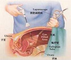 laparoscopic_1 laparoscopic_1