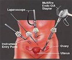 laparoscopic_2 laparoscopic_2