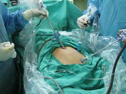 腹腔鏡手術操作過程 腹腔鏡手術操作過程